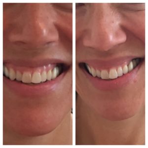 Our patient received Botox to the upper lip for a "life changing smile".